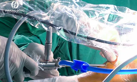 Hồi phục thần tốc sau 2 ngày phẫu thuật tái tạo dây chằng chéo bằng kỹ thuật ALL INSIDE