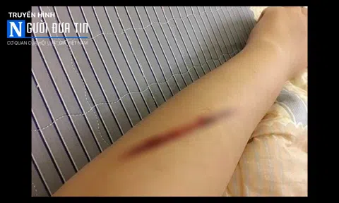 Cô gái tự rạch tay, tung tin bị cướp giữa Thủ đô 