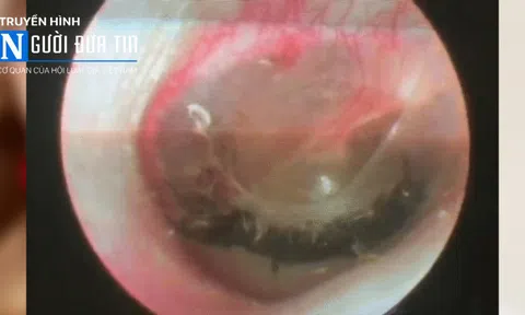Phú Thọ: Kiến sống trong tai, đi xuyên màng nhĩ bé gái 10 tuổi 