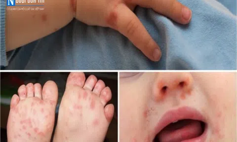 Dịch tay chân miệng bùng phát tại Hà Nội, cách phòng tránh